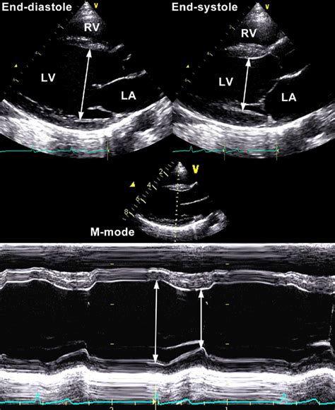 lv end diastolic dimension|Lv end diastolic diameter.